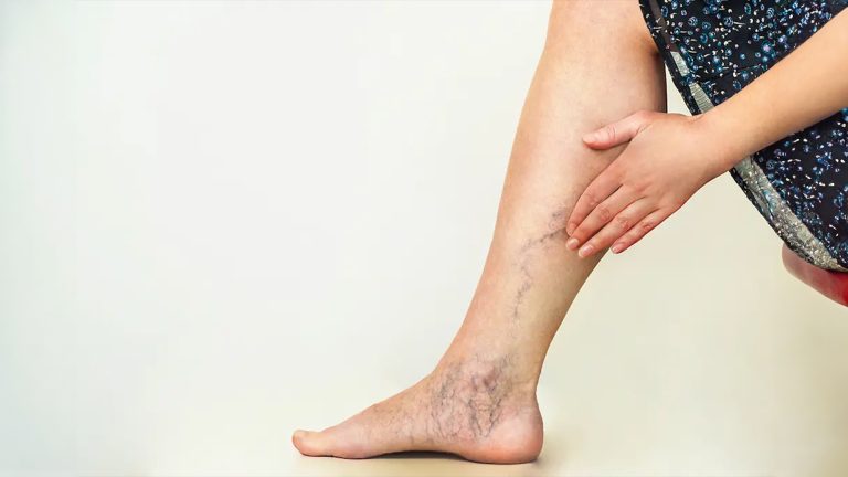 درمان واریس