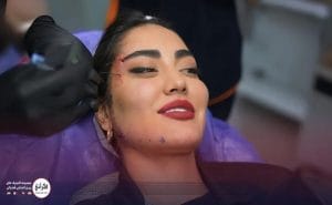 لیفت صورت با نخ