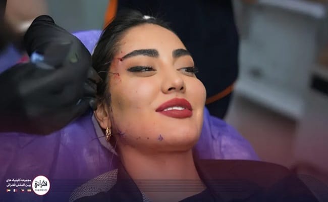 لیفت صورت با نخ