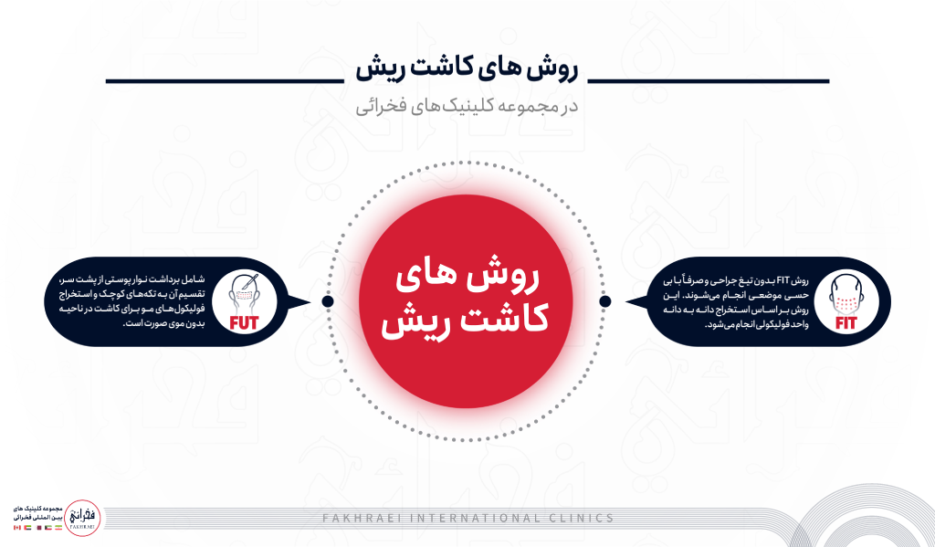 روش های کاشت ریش