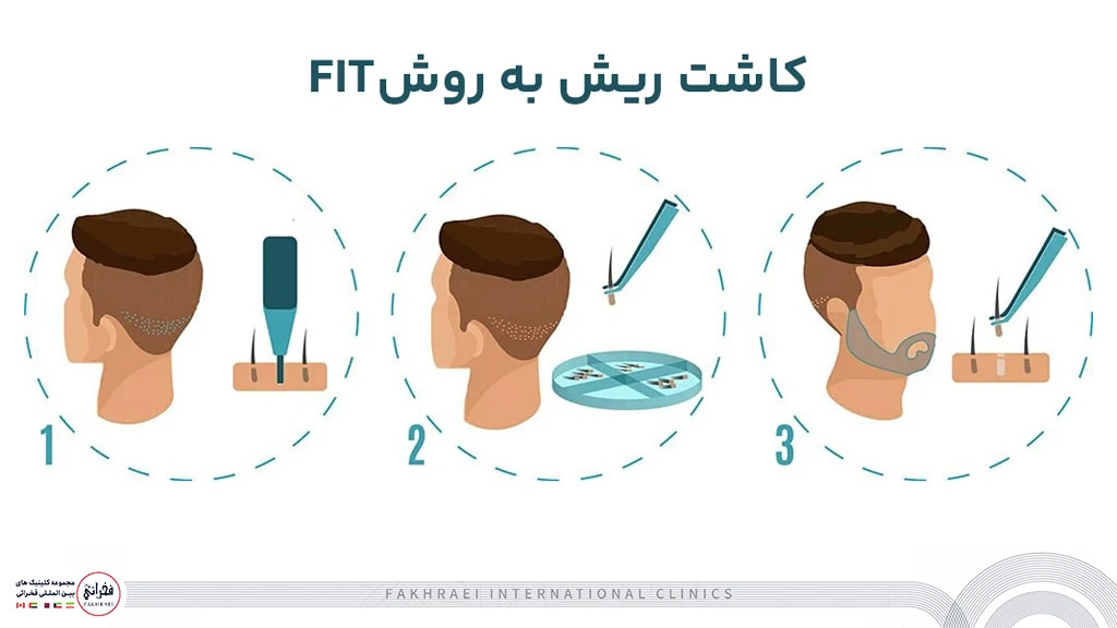 کاشت ریش به روش FIT