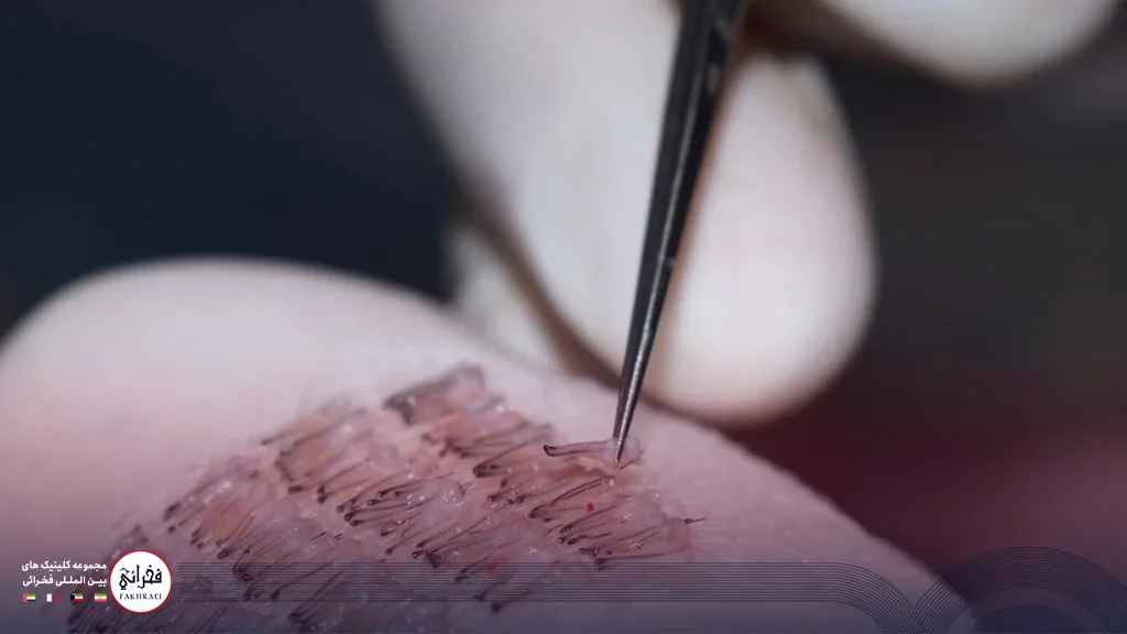 برداشت گرافت مو برای کاشت ریش