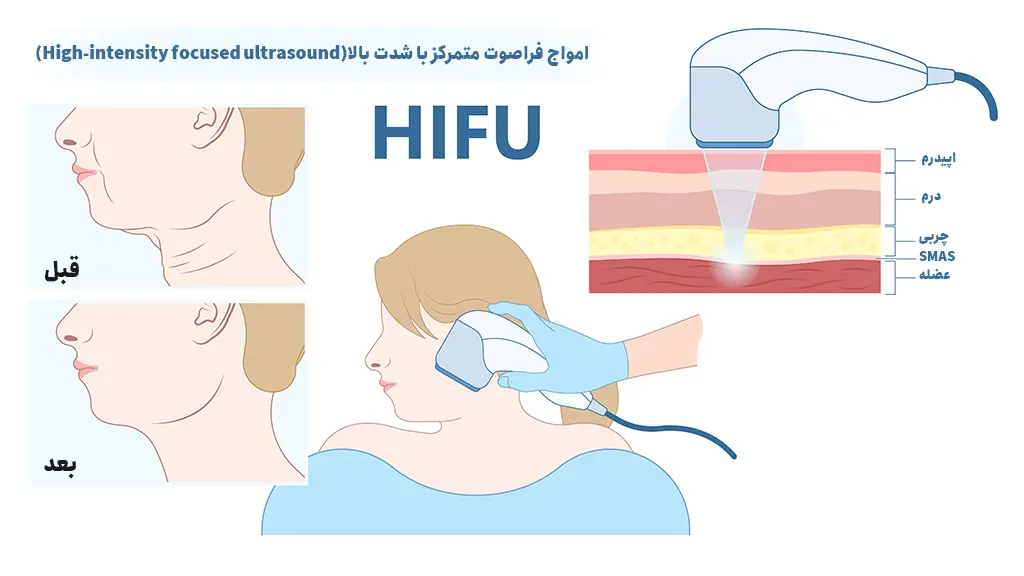 هایفوتراپی گردن چیست؟