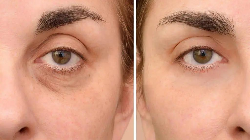 ماندگاری تزریق فیلر