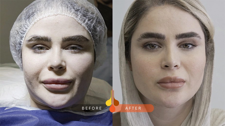 نمونه کاشت ابرو در تهران