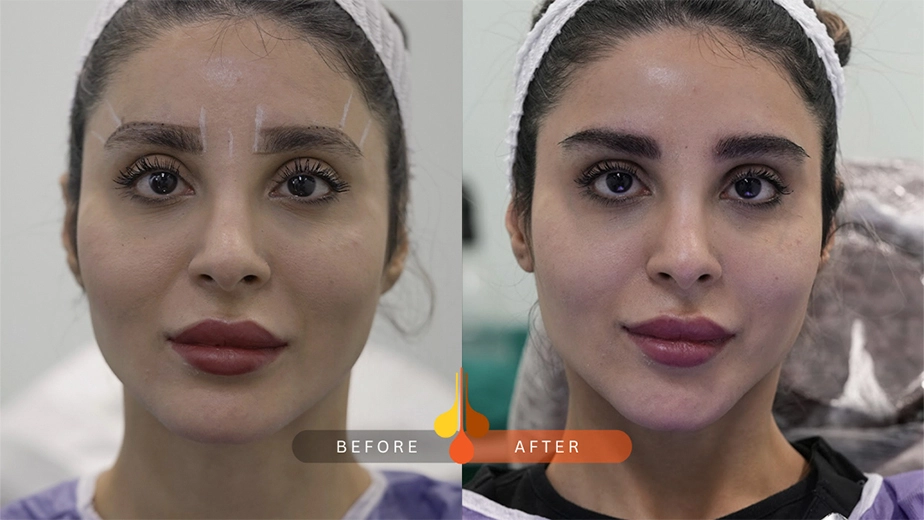 کاشت ابرو طبیعی