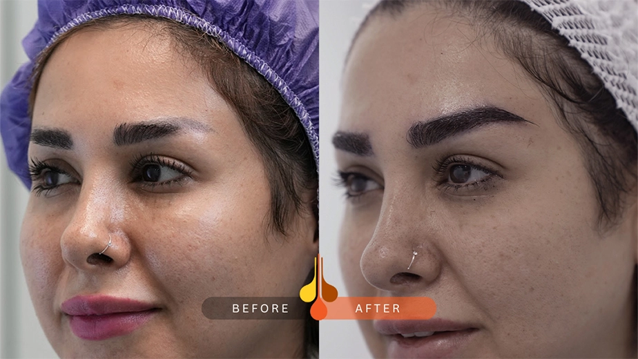 عکس کاشت ابرو طبیعی