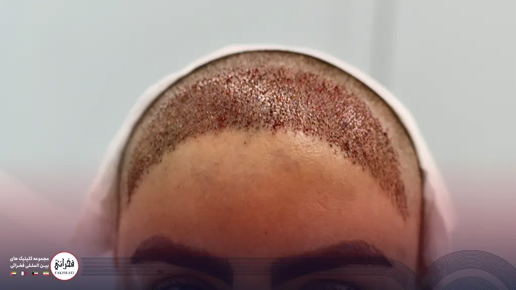 کاشت موی زنان