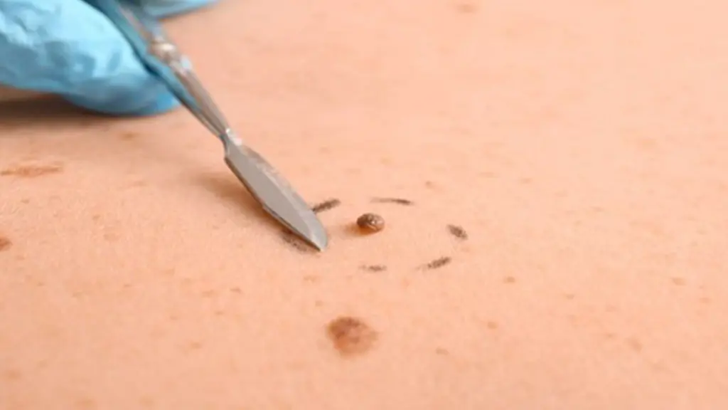 لیزر co2 برای گوشت اضافه