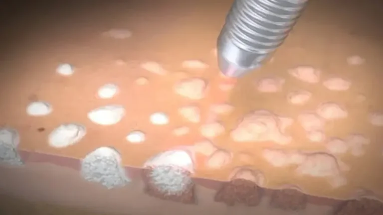 درمان زگیل تناسلی با لیزر CO2 فرکشنال | روش سریع، ایمن و بدون جراحی