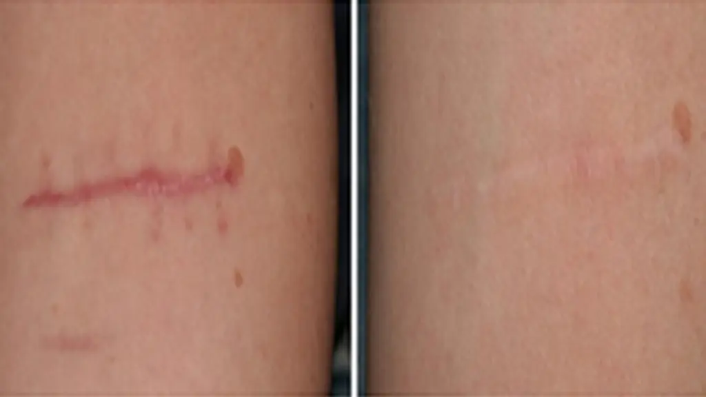 مزیتهای استفاده از لیزر CO2 برای درمان اسکار