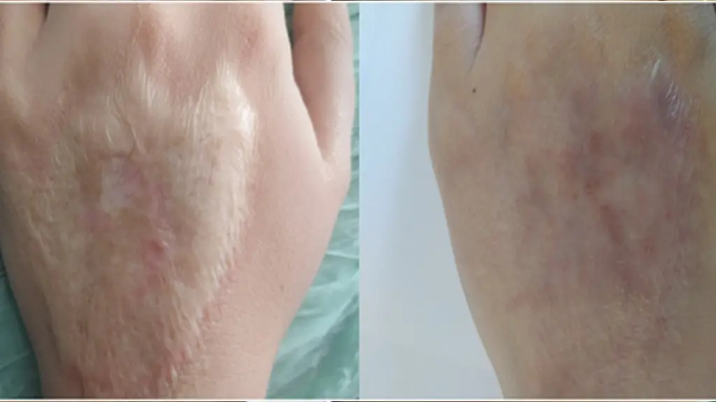 قبل و بعد لیزر co2 برای اسکار