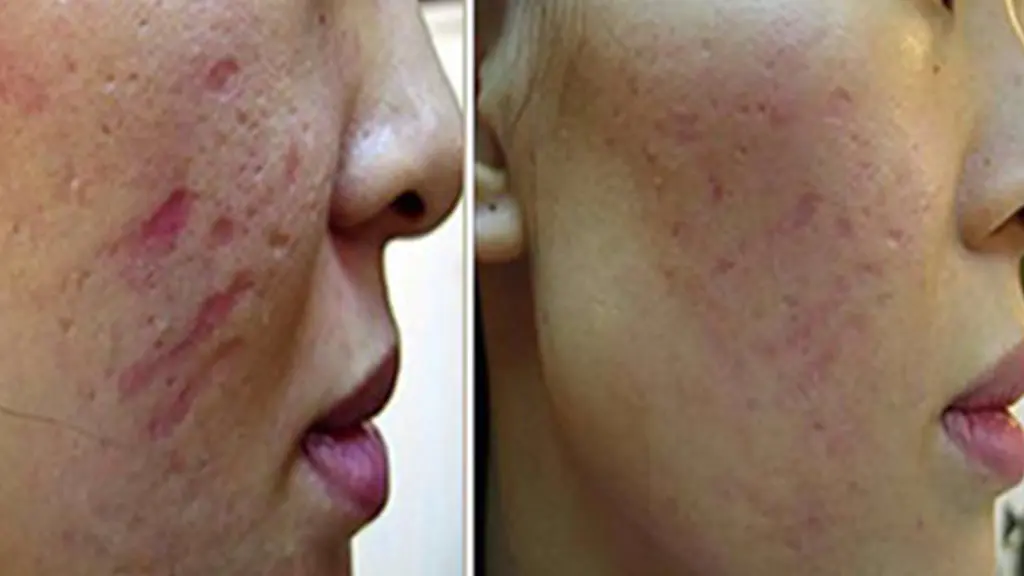 بهبودی بعد از لیزر co2 برای اسکار