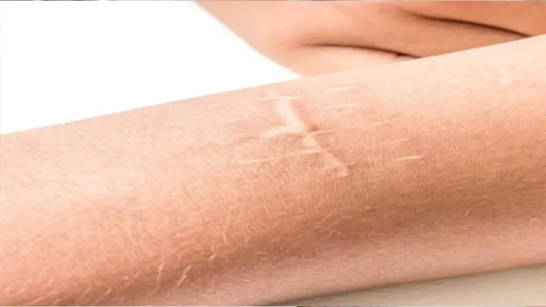 درمان قطعی جای جوش و اسکار با لیزر CO2 فرکشنال