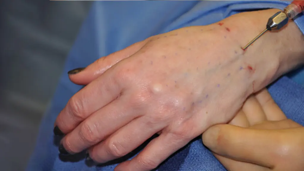 نواحی تزریق چربی به دست