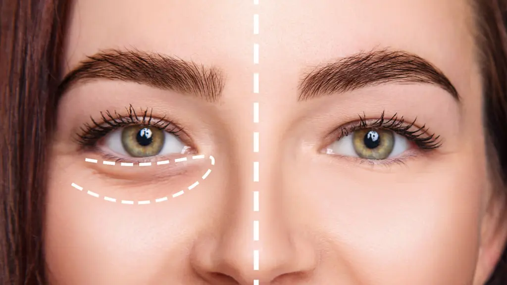 تزریق چربی زیر چشم به صورت کاملا واضح