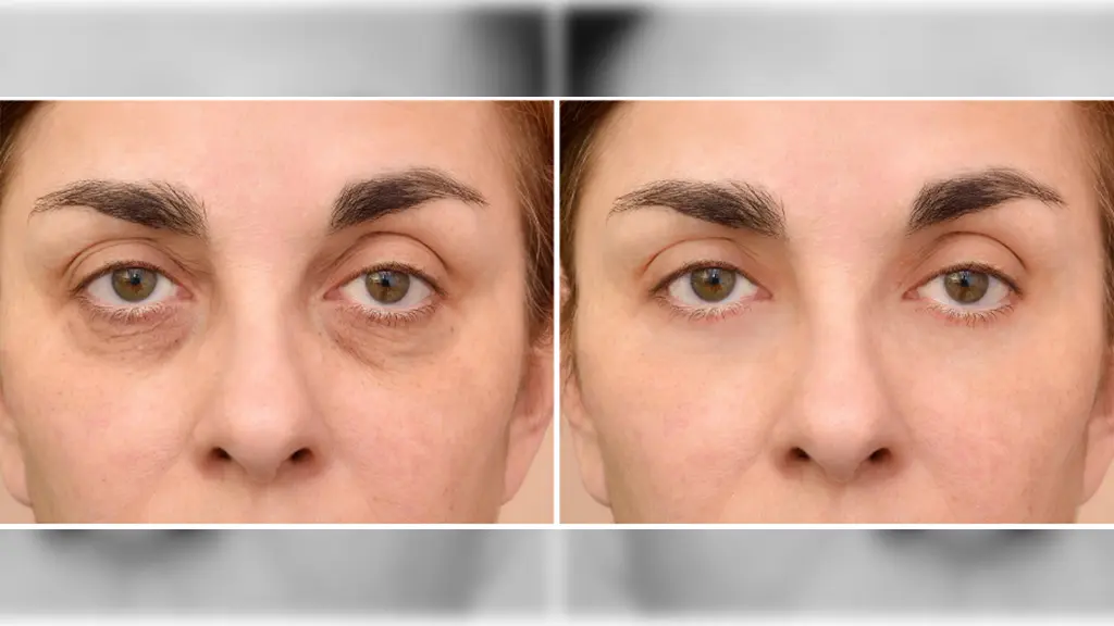 تصویر قبلو بعد از تزریق چربی زیر چشم