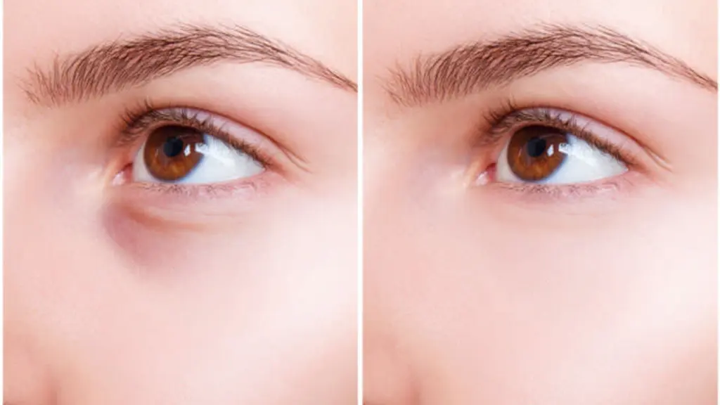 ماندگاری تزریق چربی زیر چشم