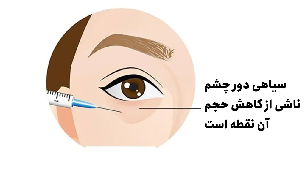 دلایل گودی زیر چشم