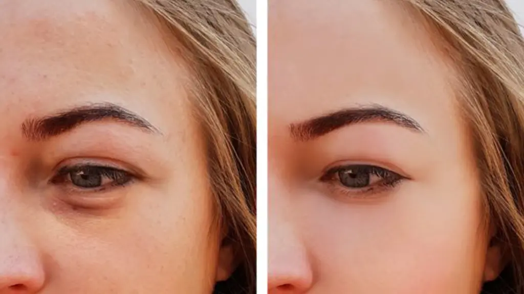 مقایسه قبل و بعد از تزریق چربی زیر چشم 