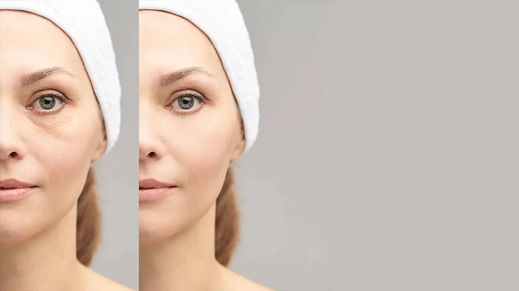 مزایای تزریق مزوژل زیر چشم