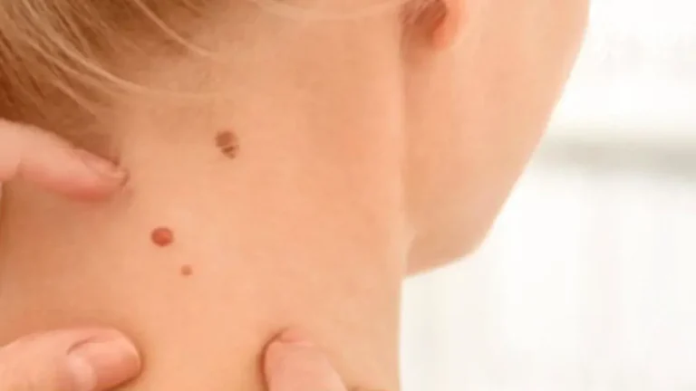 برداشتن خال با لیزر CO2 | روش سریع، بدون درد و بدون بخیه