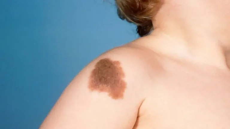 Qswitch-laser-for-Birthmark-p4