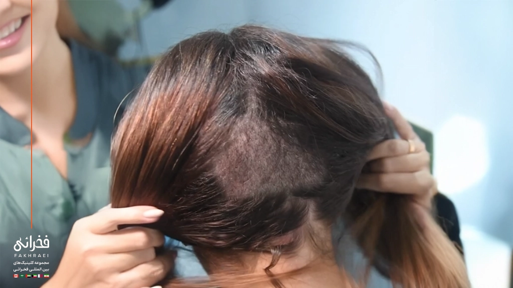 برای کاشت ابرو از کجا مو برداشته میشود؟