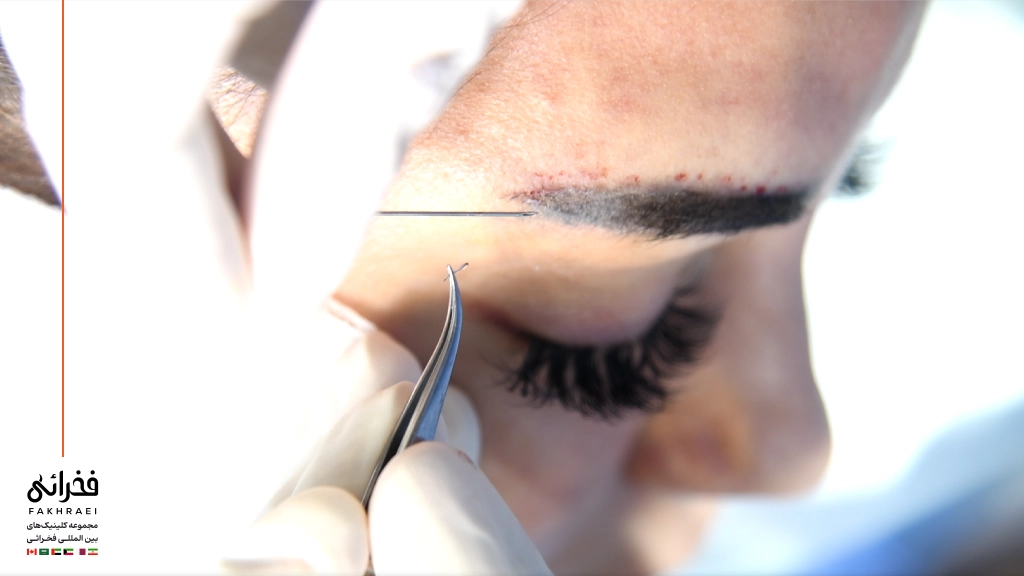 کاشت ابرو چیست؟