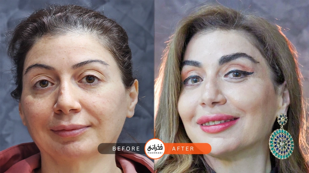 نمونه کاشت ابرو در تهران