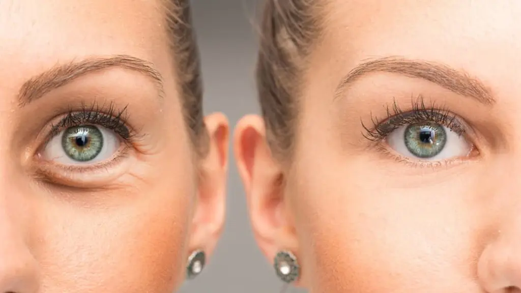 محل تزریق بوتاکس پنجه کلاغی