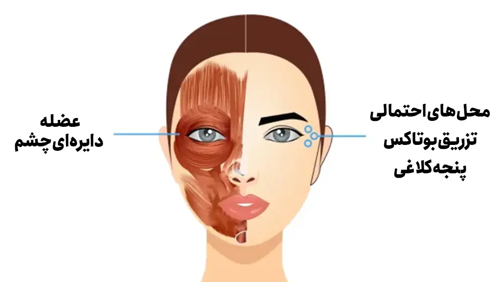 محل ایجاد خطوط پنجه کلاغی