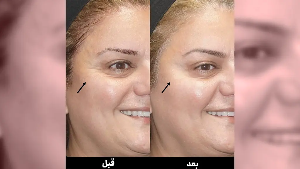 هزینه بوتاکس پنجه کلاغی