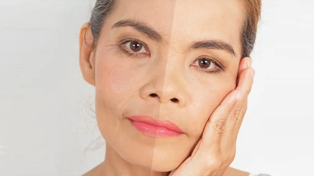 عکس قبل و بعد از تزریق بوتاکس خط خنده