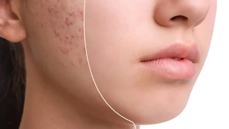 لیزر فوتونا برای لک صورت | درمان تخصصی لک، اسکار و تیرگی پوست