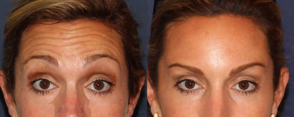 علت براق شدن پیشانی بعد از بوتاکس