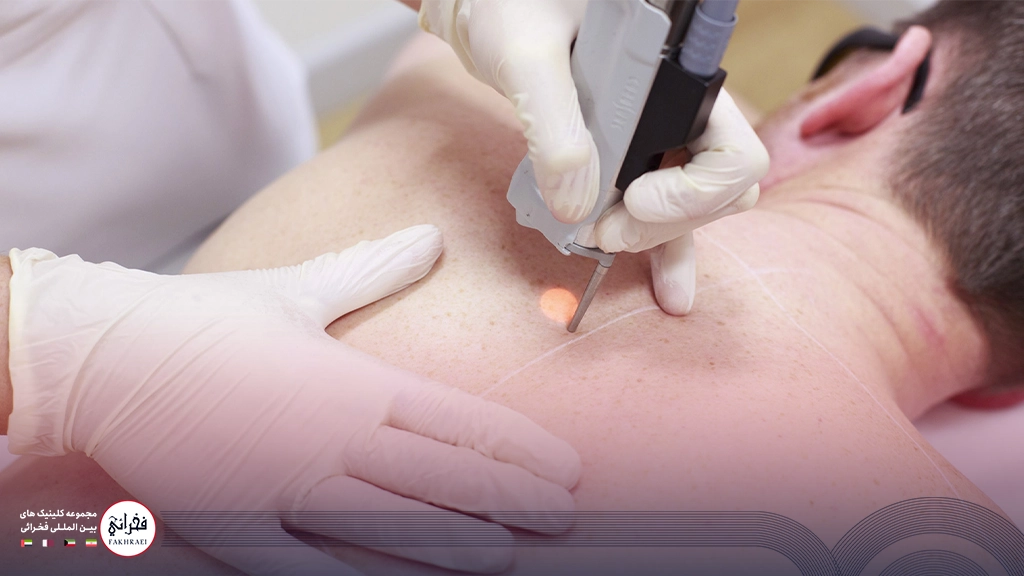 تعداد جلسات لیزر سایناشور