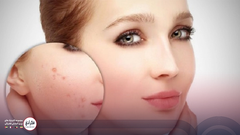 لیزر کیوسوئیچ برای لک صورت- تصویر زنی نیمرخ دایره ای روی صورتش نشان از لک داده