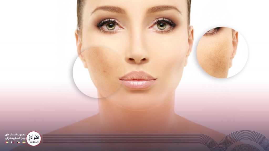 لیزر کیوسوئیچ برای لک صورت- تصویر زنی که لایه ای از صورتش لک دارد
