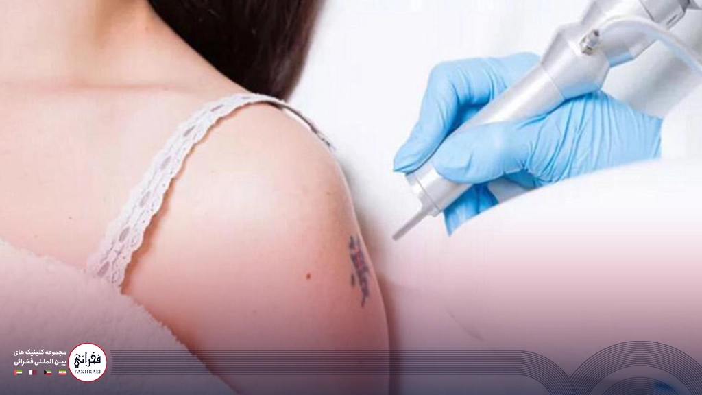 لیزر کیوسوئیچ برای لک صورت- لیزر برروی بازو خانمی با تتو