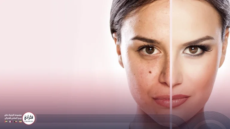 لیزر کیوسوئیچ برای لک صورت | درمان قطعی لک و آکنه