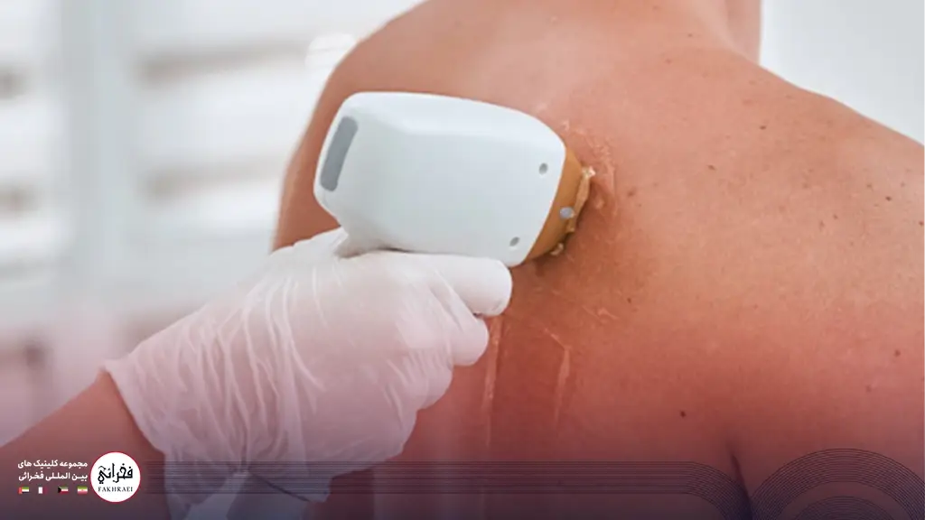 راه‌های پیشگیری از عوارض لیزر موهای زائد مردان