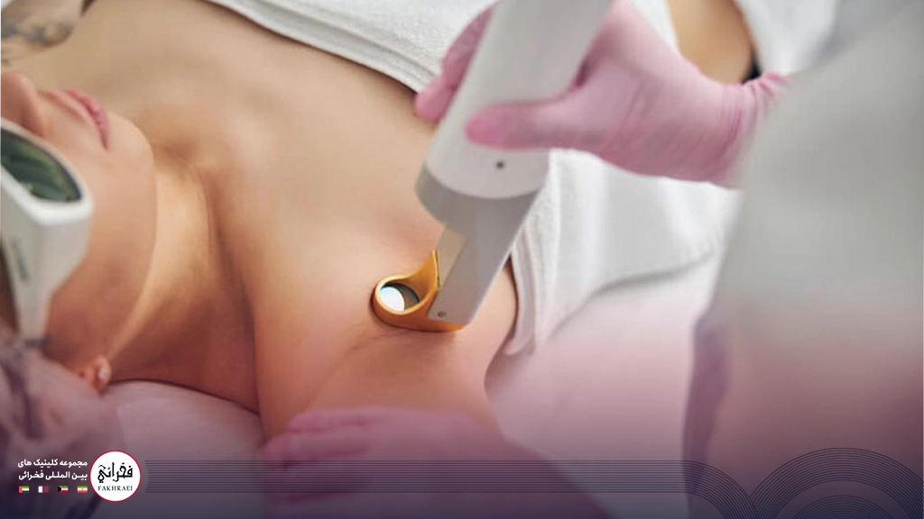 لیزر کیوسوئیچ برای زیر بغل-زیر بغل زنی در حال انجام لیزر