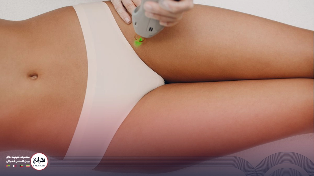 لیزر CO2 بیکینی-زنی در حال انجام لیزر کشاله ران