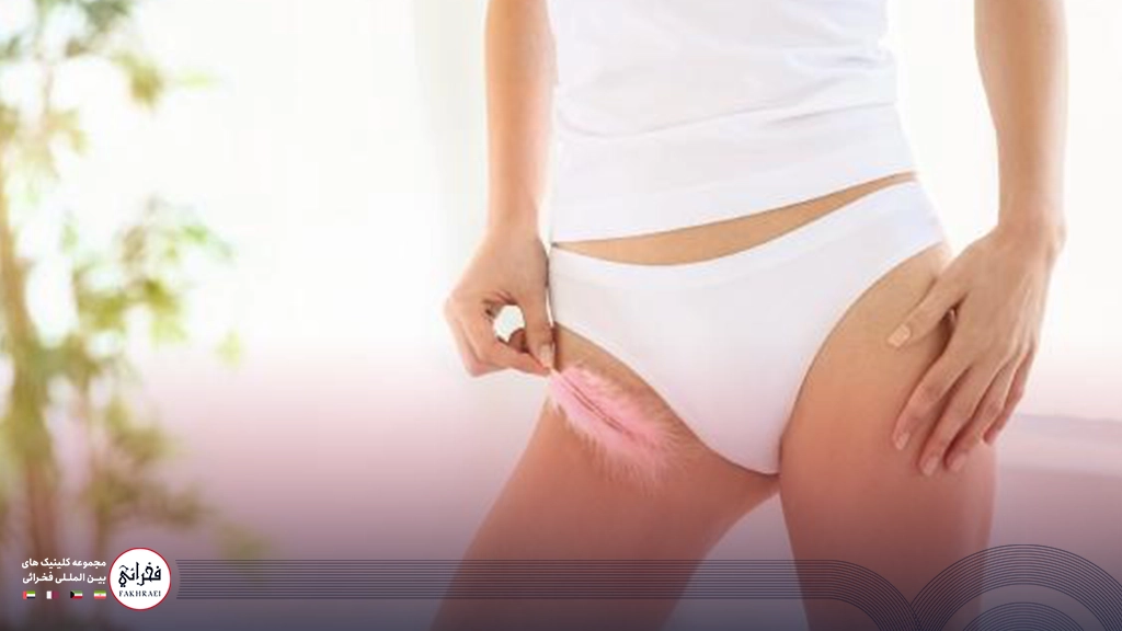 لیزر CO2 بیکینی- زنی که پری در دست گرفته و روی پای خود می کشد