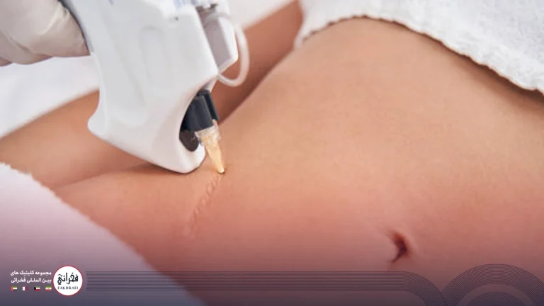 لیزر فوتونا برای جای بخیه