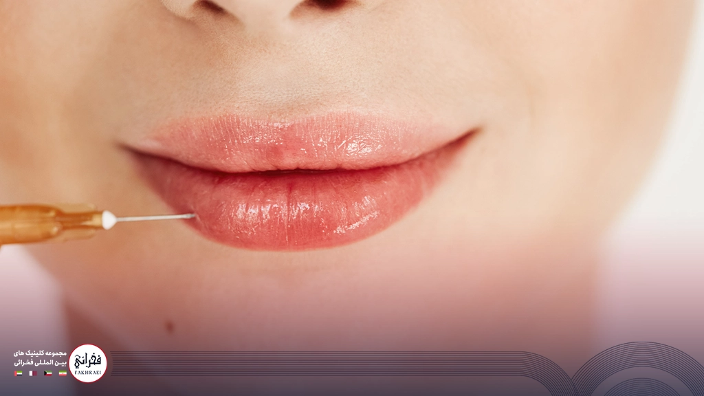 تزریق ژل لب مدل صدفی-تزریق ژل به لب خانومی