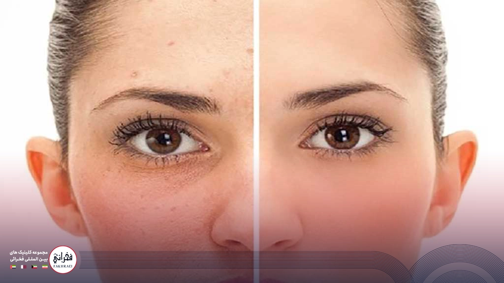 درمان لک صورت با لیزر CO2