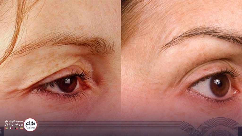 هایفوتراپی پلک-زنی با پلک چین وچروک دار بدون آ