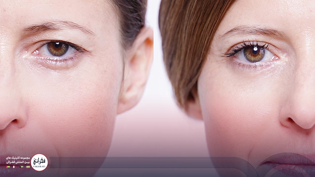 هایفوتراپی پلک-تصویر دوزن با دو پلک متفاوت